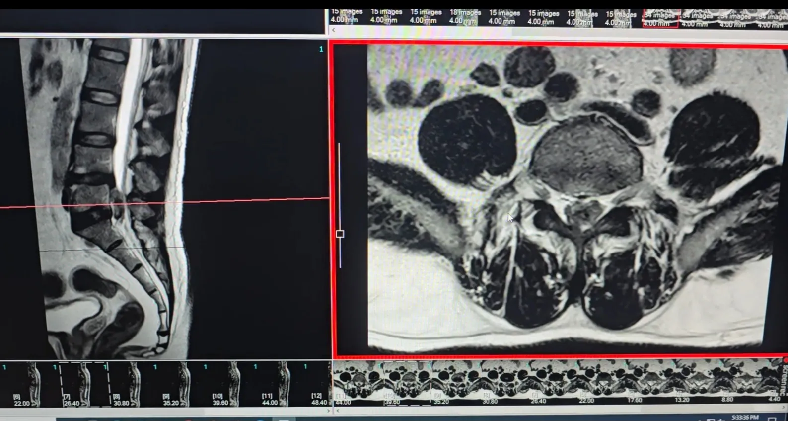 MRI diagnosis