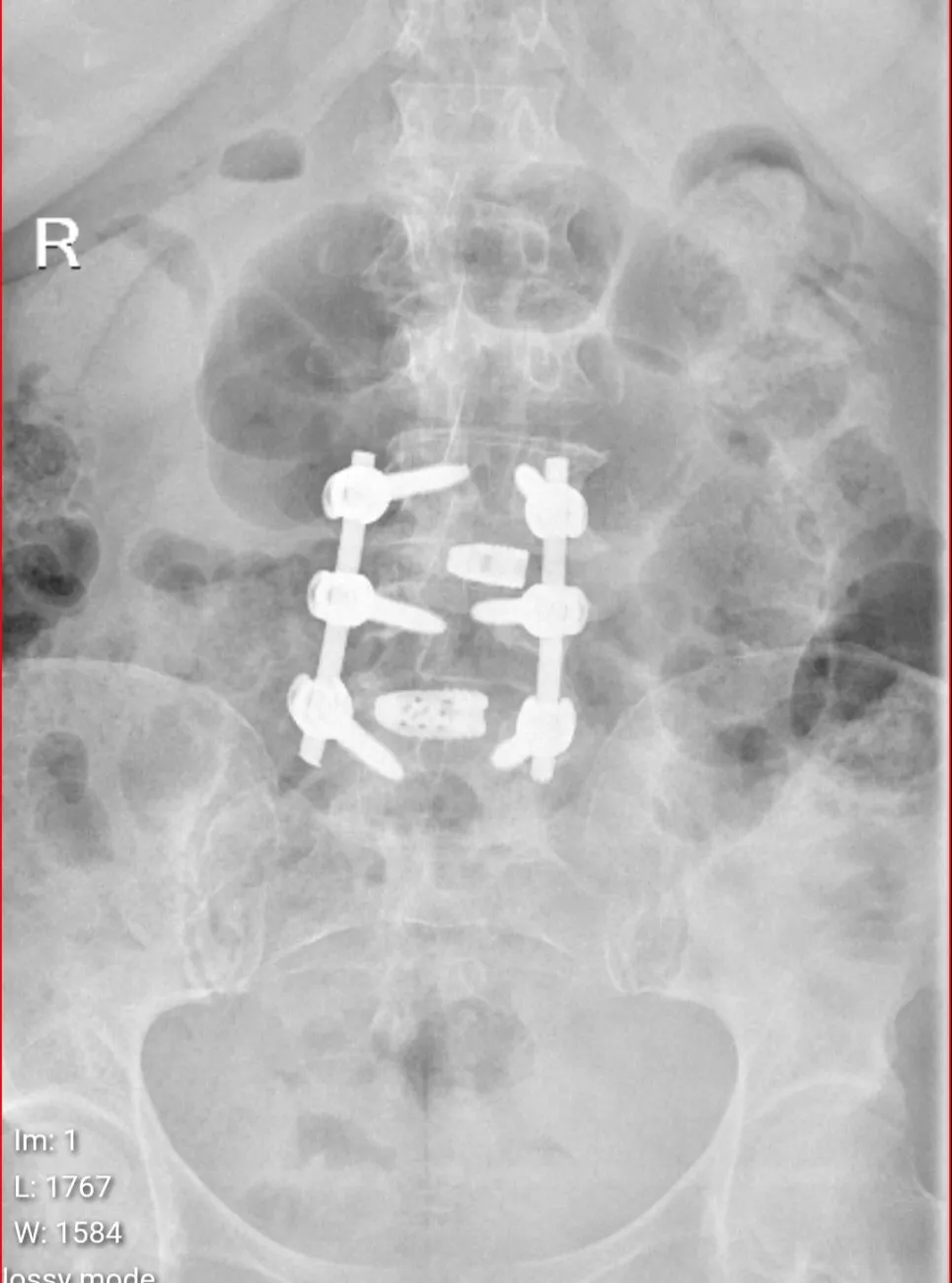 Spinal fusion surgery